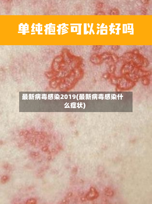最新病毒感染2019(最新病毒感染什么症状)-第2张图片